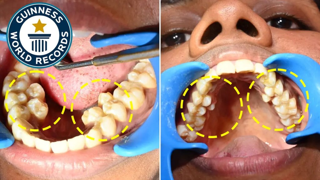 26 year old Indian Mother has the most teeth Won the title of Guinness Book of World Records