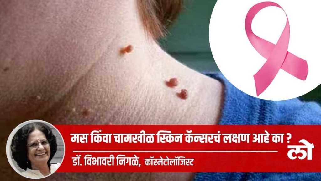 mole or wart symptom of skin cancer in marathi, treatment on mole or wart in marathi