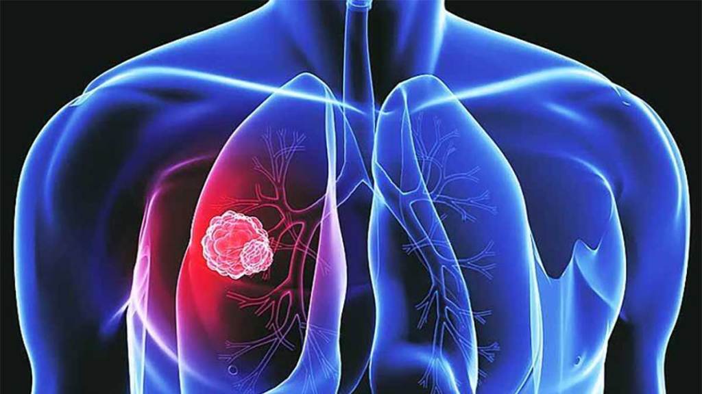 lung cancer diagnosis in just 10 minutes by oncopredict test