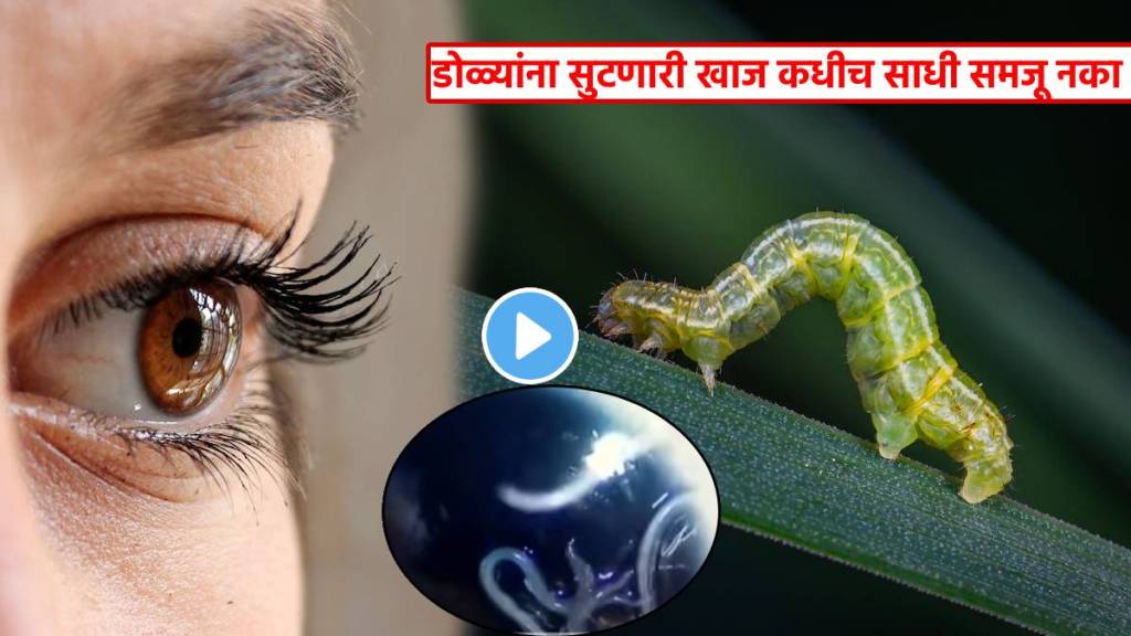 60 Alive Worms Removed From Womens Eyes After She Complains Itching In ...