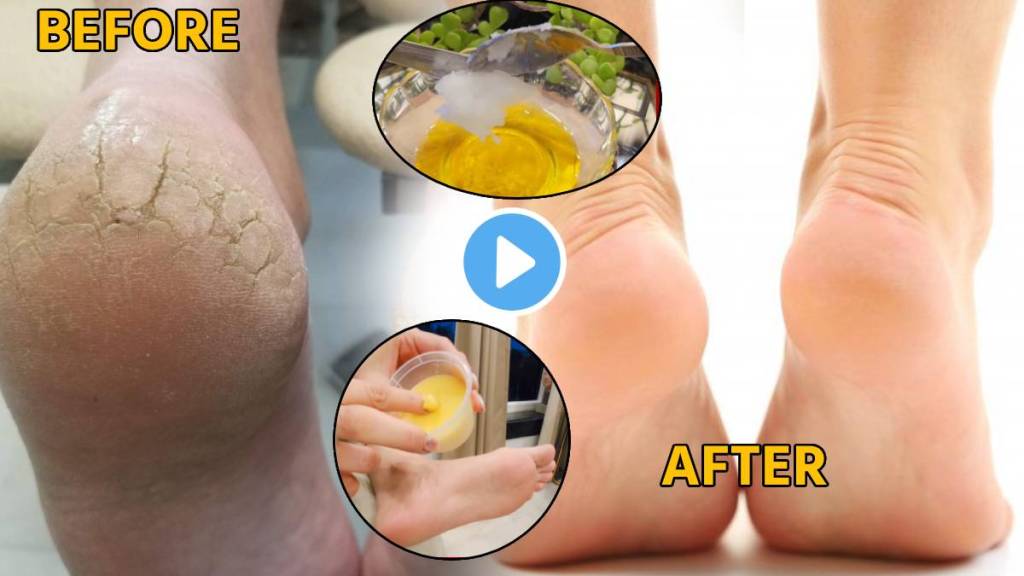 2 Camphor Kapur Balls With Coconut Oil Solution For Cracked Heels In Winter Home Remedies Watch Video Making Moisturizer