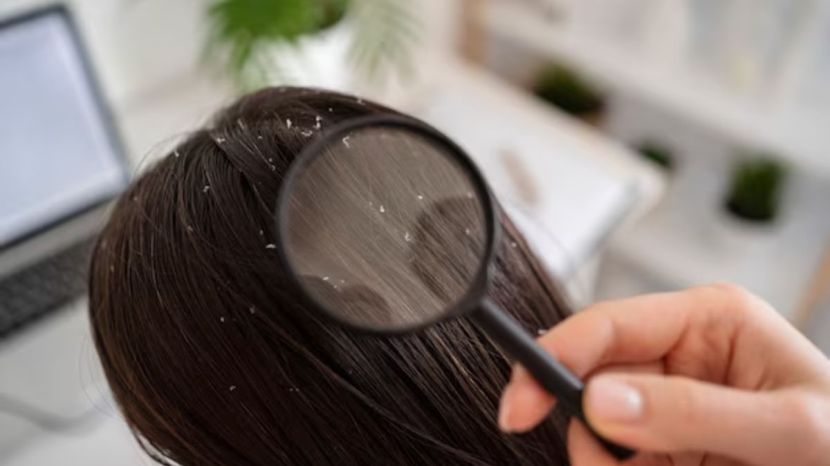 how to stop increasing dandruff during winter season