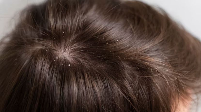 how to stop increasing dandruff during winter season