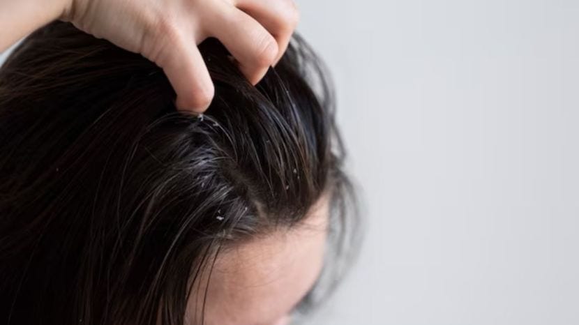 how to stop increasing dandruff during winter season