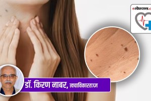 skintags marathi, skintags treatment marathi, how to remove skintags marathi, how to remove warts marathi,