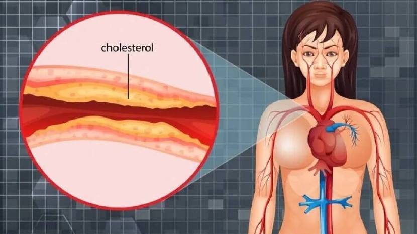 Bad Cholesterol Increased Shows Signs On Face Skin Nails Legs Does Yellow Stains Means Cholesterol or Jaundice Body Signs Health