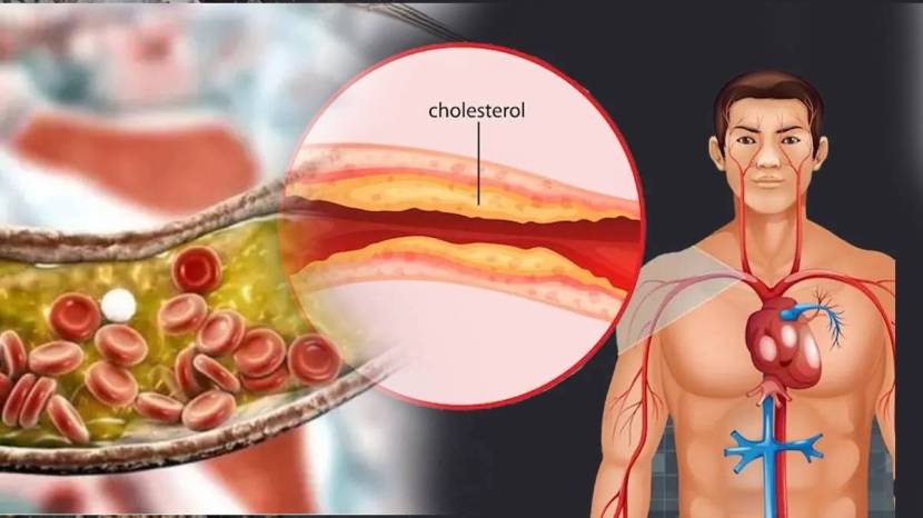 Bad Cholesterol Increased Shows Signs On Face Skin Nails Legs Does Yellow Stains Means Cholesterol or Jaundice Body Signs Health