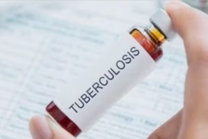 tuberculosis marathi news, tuberculosis genetic sequencing marathi news