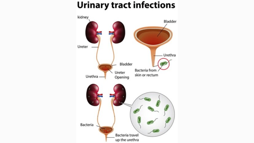 Holding pee for long time is harmful for health know four possible complications 