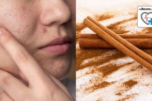 Can cinnamon treat acne