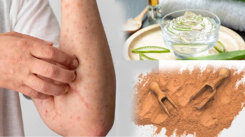 Are Rashes Troubling You Here are Five Natural Home made Remedies To Beat Your Heat Rash must follow 