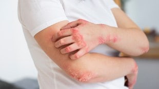 Fungal Infection In Monsoon How To Effectively Ward Off Fungal Infections During The Monsoon