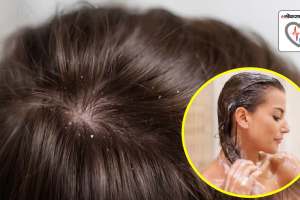 can washing your hair regularly for 21 days keep dandruff away what dermatologist experts said read