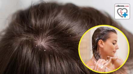 can washing your hair regularly for 21 days keep dandruff away what dermatologist experts said read