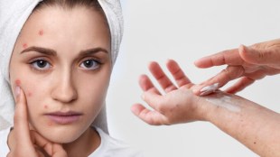 How to protect your skin from common infections during monsoon Tips