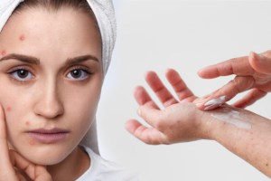 How to protect your skin from common infections during monsoon Tips