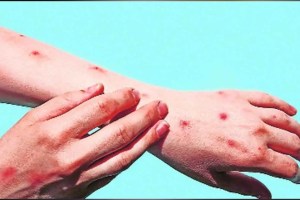 pune doctors spread rumours of monkeypox