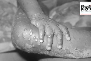 monkeypox india