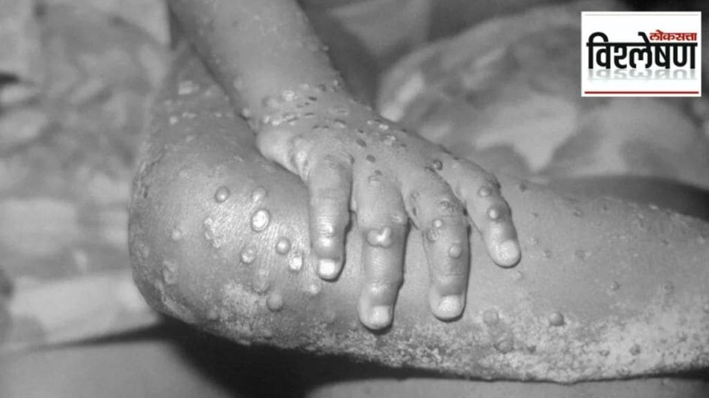 monkeypox india