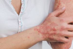 effective treatment on psoriasis with side effects advice from dermatologist