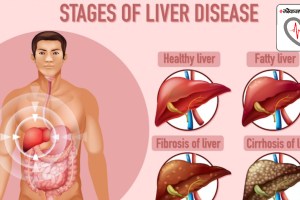 healthy liver: 1-3 of 10 Indians have liver disease, says health ministry; here’s how to ensure you’re safe