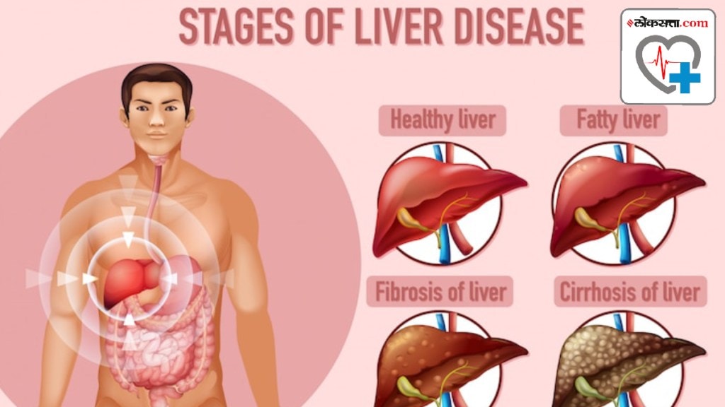 healthy liver: 1-3 of 10 Indians have liver disease, says health ministry; here’s how to ensure you’re safe