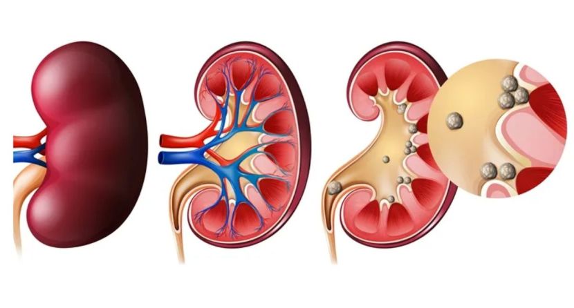 kidney-stone-causes-food