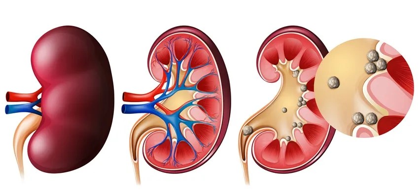 Risks of kidney stone surgery