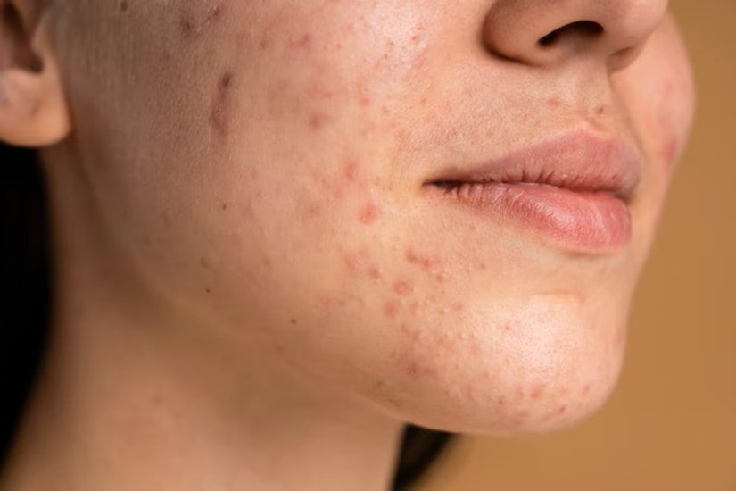 Causes of open pores