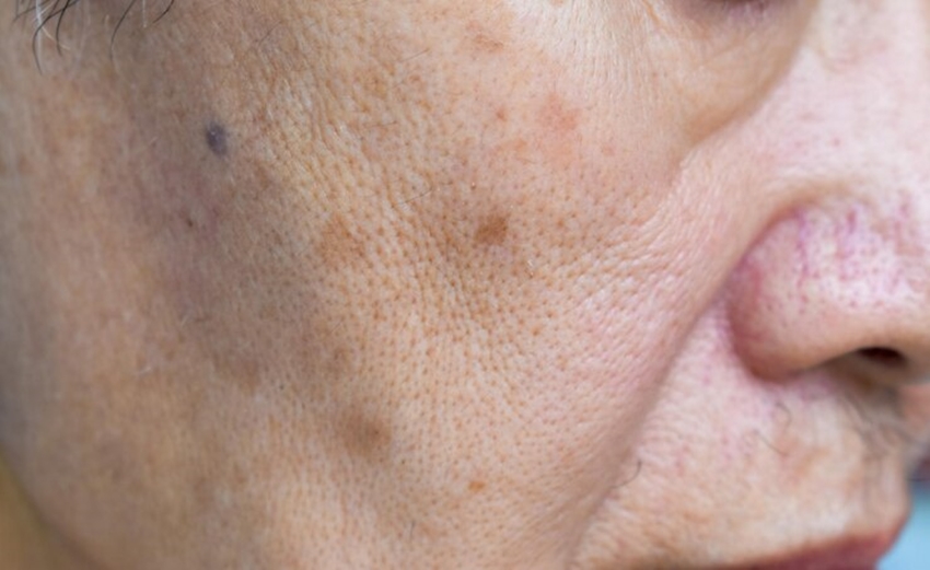 pores on the face