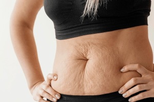 Stretch marks home remedies and clinical treatments to lighten them effective method