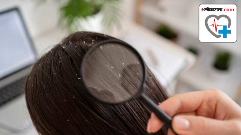 season do hair lice occur