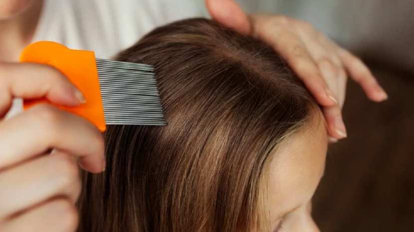 Expert tips to get rid of head lice