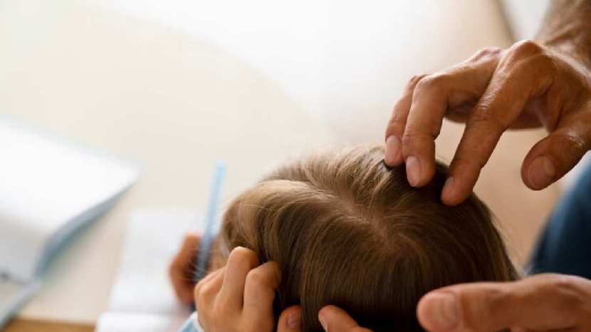 Expert tips to get rid of head lice