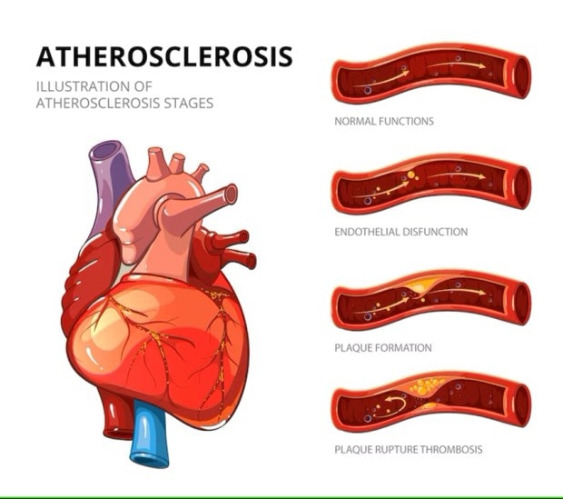 atherosclerosis-fibrous-plaque-formation-medical-human-health-graphic-thrombus-vessel-vector-illustration-infographic