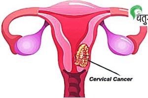 cervical cancer chatura article loksatta