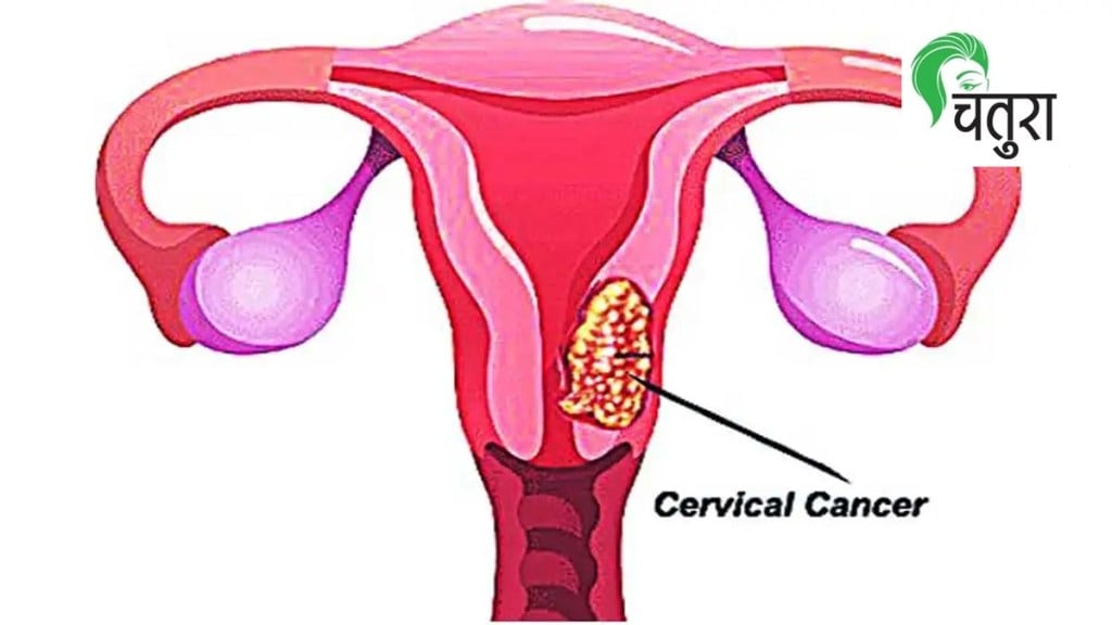 cervical cancer chatura article loksatta