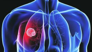 Pollution increases risk of lung disease Bad air has long-term health effects