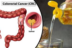 Common cooking oil fueling colon cancer in young Americans: What a new study says Cooking oil and cancer