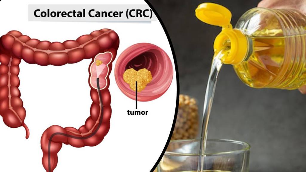 Common cooking oil fueling colon cancer in young Americans: What a new study says Cooking oil and cancer