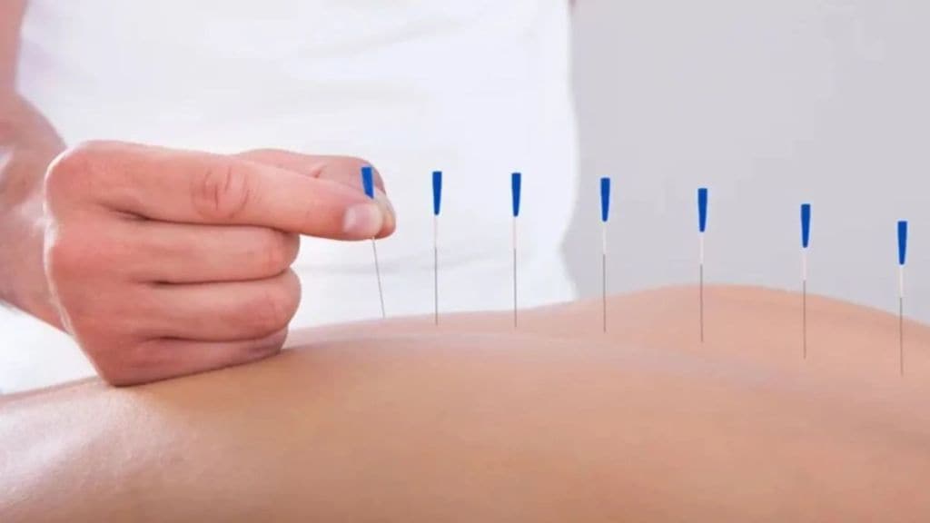 12 colleges in state offering acupuncture treatment for first time