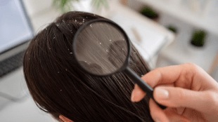 dandruff remedy Dandruff home remedies use this ingredient to get rid of Dandruff this winter