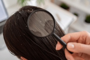 dandruff remedy Dandruff home remedies use this ingredient to get rid of Dandruff this winter