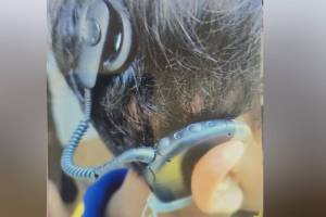 Hearing aid worth Rs 5 lakh stolen while boarding bus police face challenge to find it