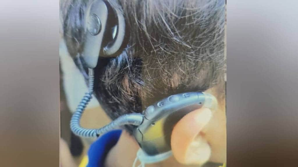 Hearing aid worth Rs 5 lakh stolen while boarding bus police face challenge to find it