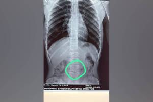 young man swallowed nail during carpentry