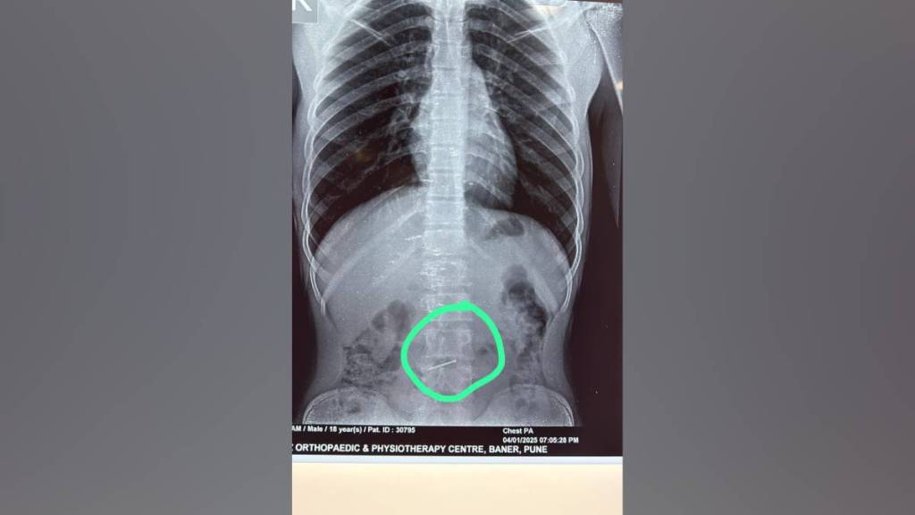 young man swallowed nail during carpentry