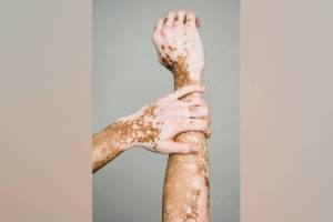 Vitiligo , Vitiligo groom bride, white spot,