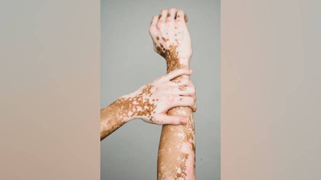 Vitiligo , Vitiligo groom bride, white spot,