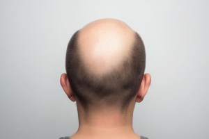 Hair , bald , Buldhana, Ayurveda, Homeopathy ,